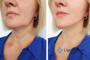 Double chin before and after Hi-Fu treatment 4 Book your double chin treatment Heanor today! We are here to help!