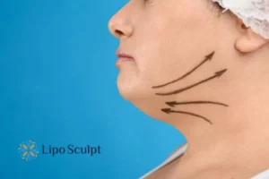 Double chin before and after Hi-Fu treatment 3 Boost your confidence with a Double chin treatment Heanor