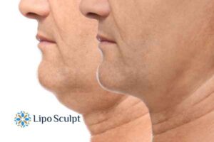 Double chin before and after Hi-Fu treatment 2 Double chin treatment Heanor from Lipo Sculpt - feel more confident today!