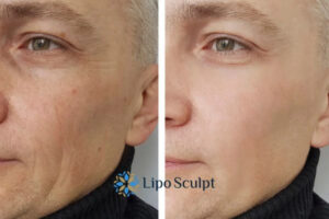 How to Fight Aging Symptoms 3 Fight Aging Symptoms Heanor With HIFU and Morpheus8 Today!
