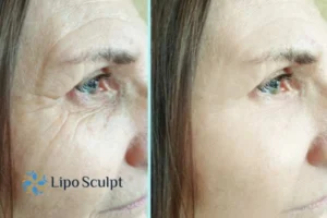 How to Fight Aging Symptoms 2 Do you want to Fight Aging Symptoms Heanor? Contact Lipo Sculpt today!