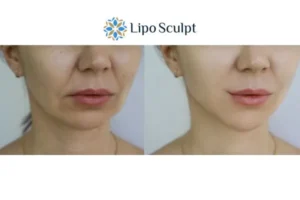 Explaining Total Skin Tightening Treatment And What It Can Do For You 2 Do you want to boost your self confidence? Give Morpheus8 Heanor a try today!