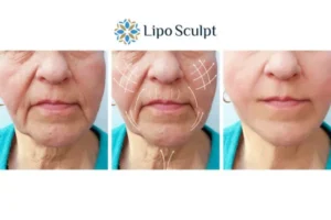 Explaining Total Skin Tightening Treatment And What It Can Do For You 3 Boost your confidence with Morpheus8 Heanor call our team today!