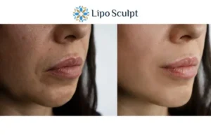 Explaining Total Skin Tightening Treatment And What It Can Do For You 4 Morpheus8 Heanor the best results - call our team today!