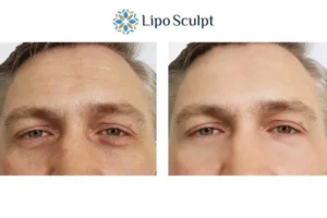 Explaining Total Skin Tightening Treatment And What It Can Do For You 6 Morpheus8 Heanor book in today to find out more!