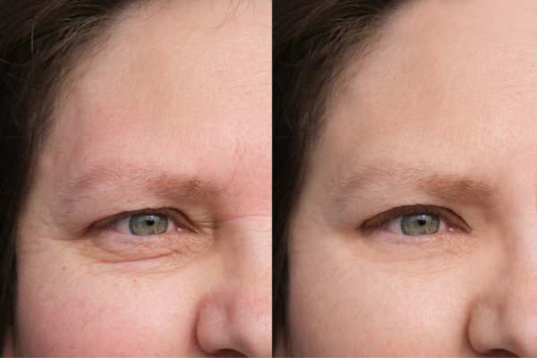 HIFU vs Botulinum Toxin: Understanding the Differences 4 How long do HIFU results last Heanor?
