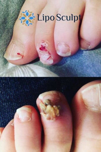 Wart removal customer results from Lipo Sculpt Heanor