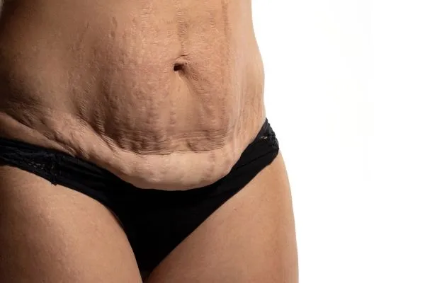 Lost the Weight but Not the Loose Skin? 1 image of womans stomach after weight loss showing loose skin Heanor